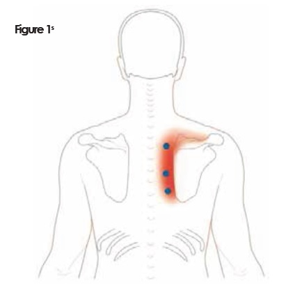 Trigger Point Grand Rond COMPARISON OF TRIGGER POINT PRESSURE RELEASE WITH ULTRASOUND THERAPY TO ...